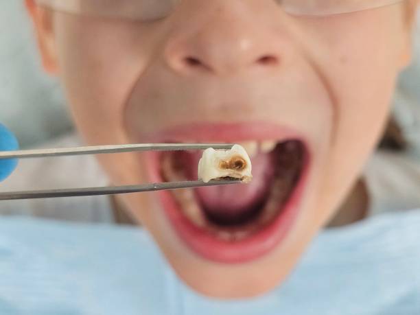 Best Emergency Broken Tooth Repair in Gordonsville, TN