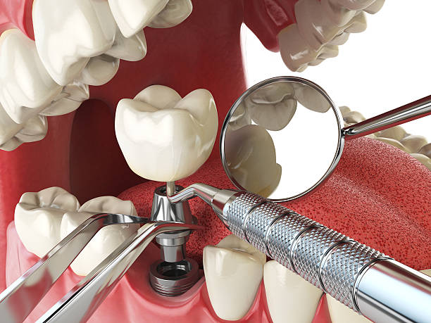 Best Emergency Wisdom Teeth Removal in Gordonsville, TN